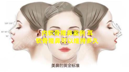 内软骨隆鼻案例 耳软骨隆鼻可以维持多久